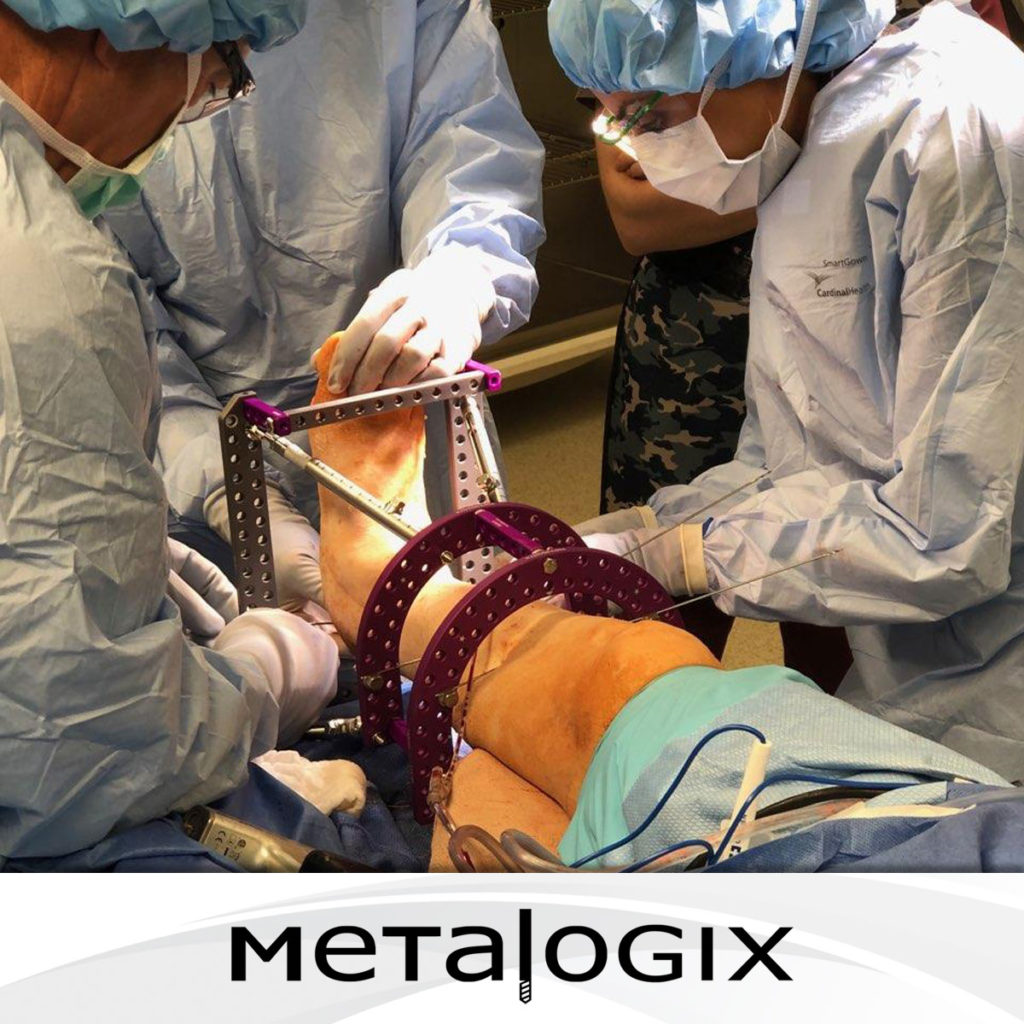 Surgeon using Metalogix Revolution External Plating System