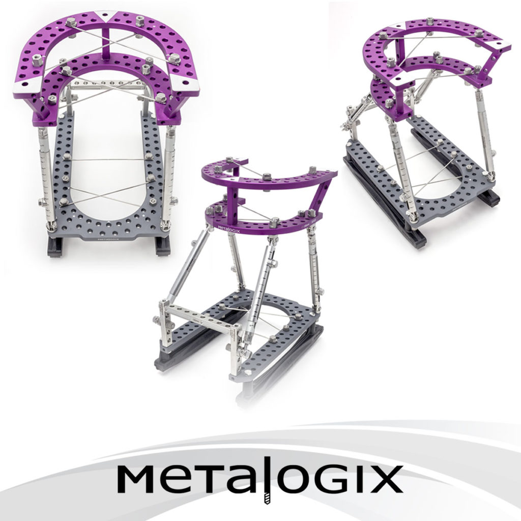 Metalogix External Fixation System Charcot Construct