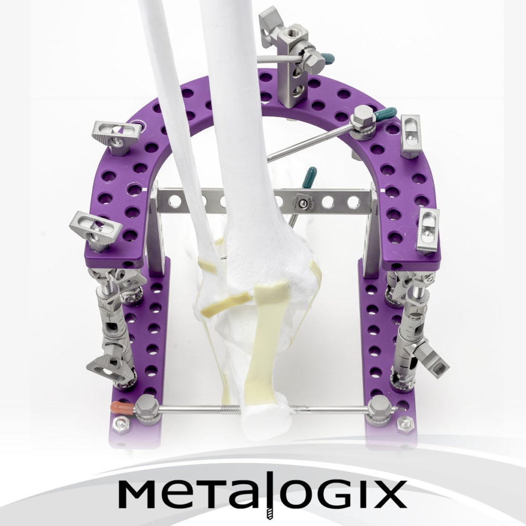Metalogix External Fixation System ACFAS