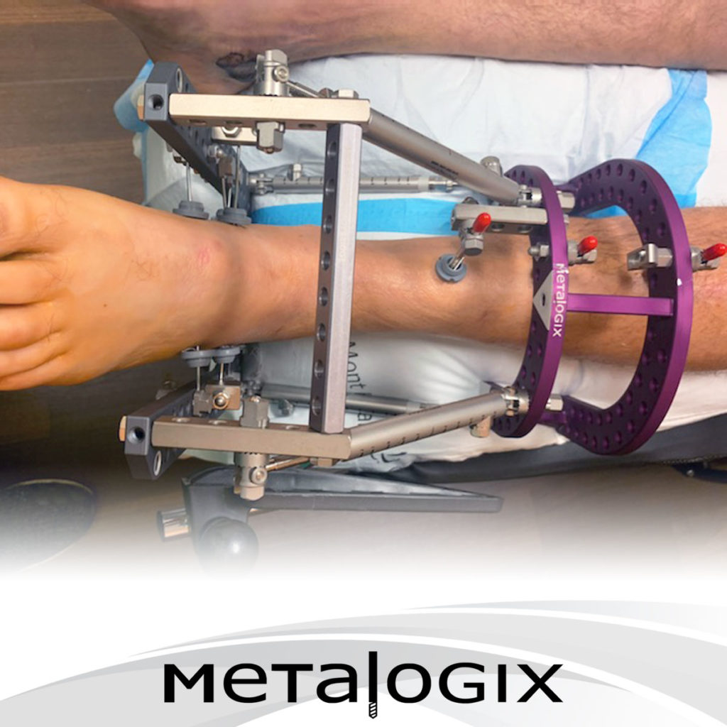 Calcaneus fracture stabilized with Metalogix Revolution External Fixation System