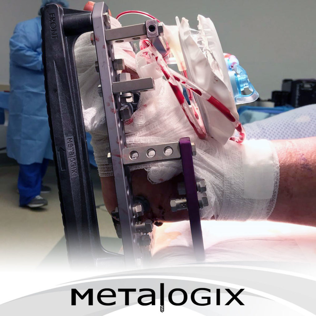 Talectomy using Metalogix Revolution External Fixation System