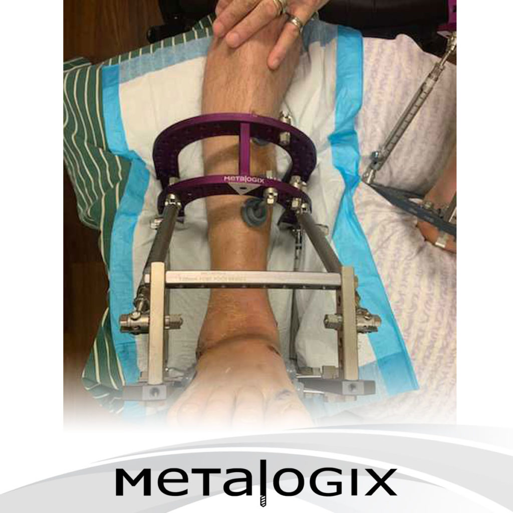 Metalogix Revolution Calcaneal Fracture