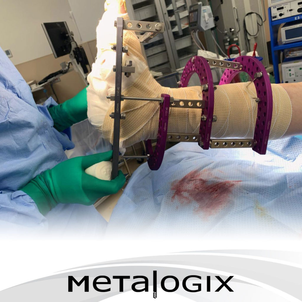 Dr. Jeff Holmes, DPM uses Revolution External Fixation System