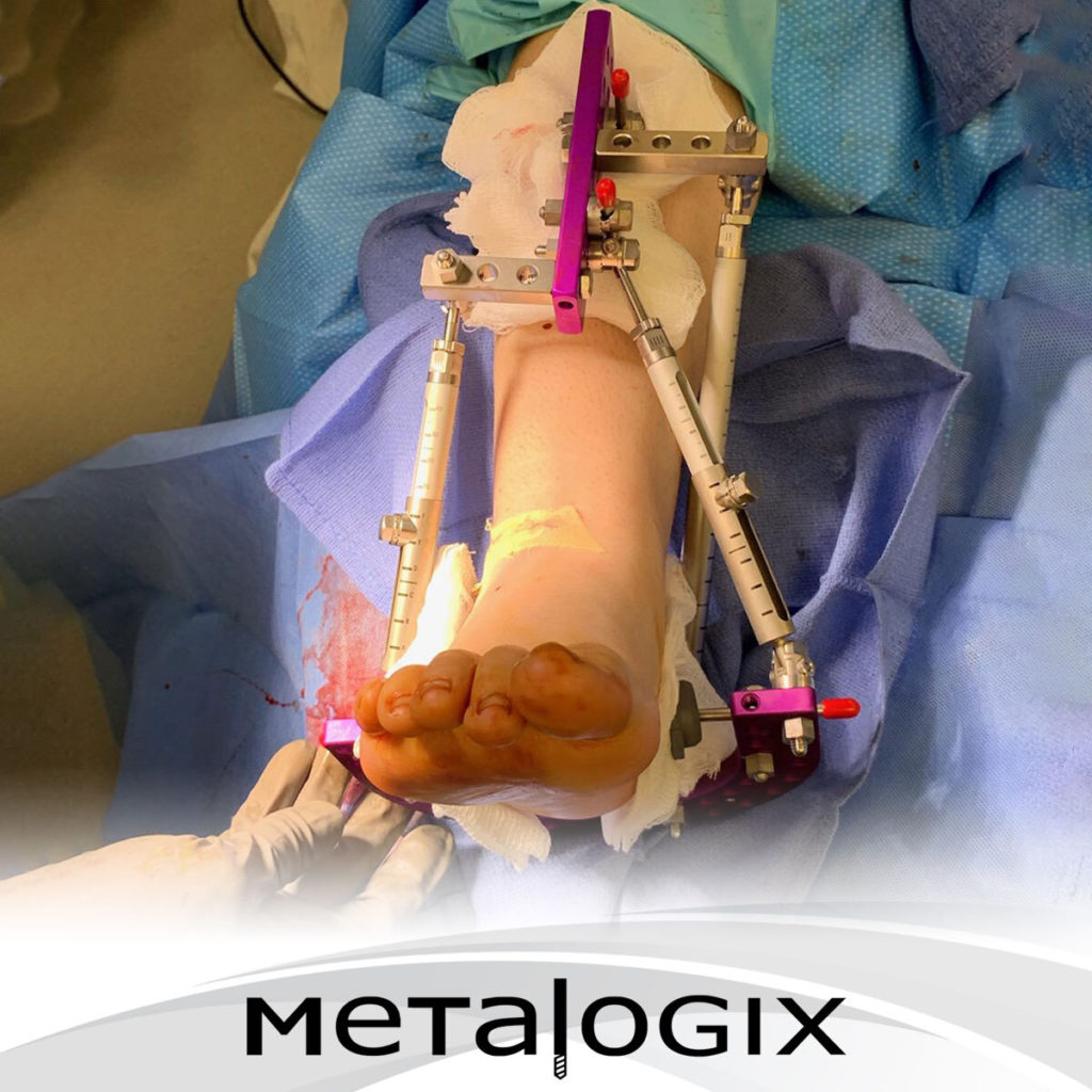 Metalogix Revolution External Fixation n-Plate and i-Plate Lee M. Hlad