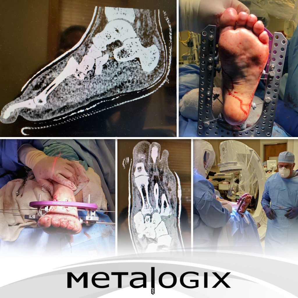 metalogix plating system peter bishop dpm acfas