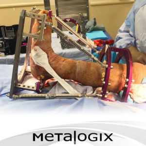 Metalogix Revolution Charcot Surgery