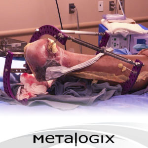 Limb Salvage using Metalogix Revolution External Plating System