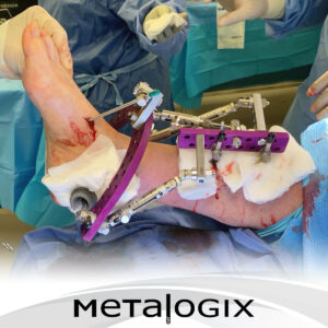 Metalogix Revolution External Plating System