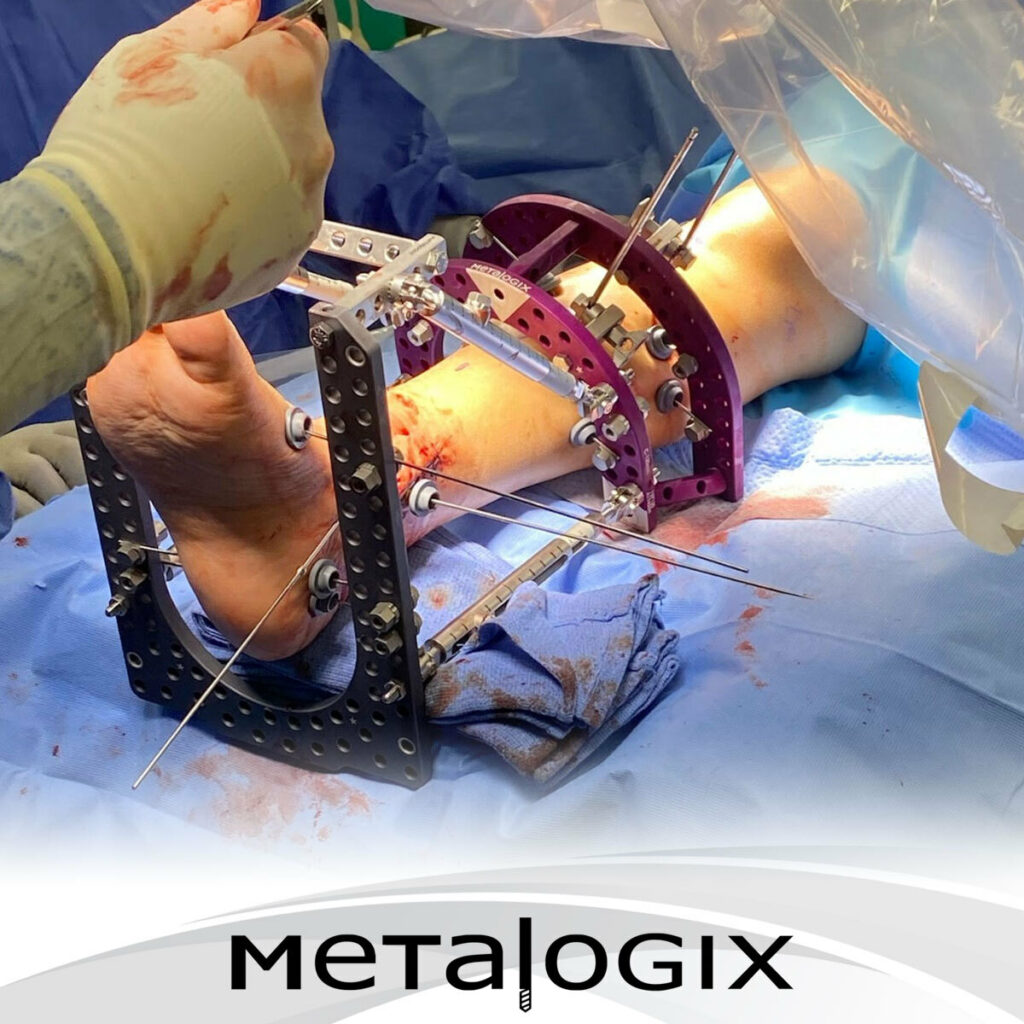 Metalogix Revolution External Plating System